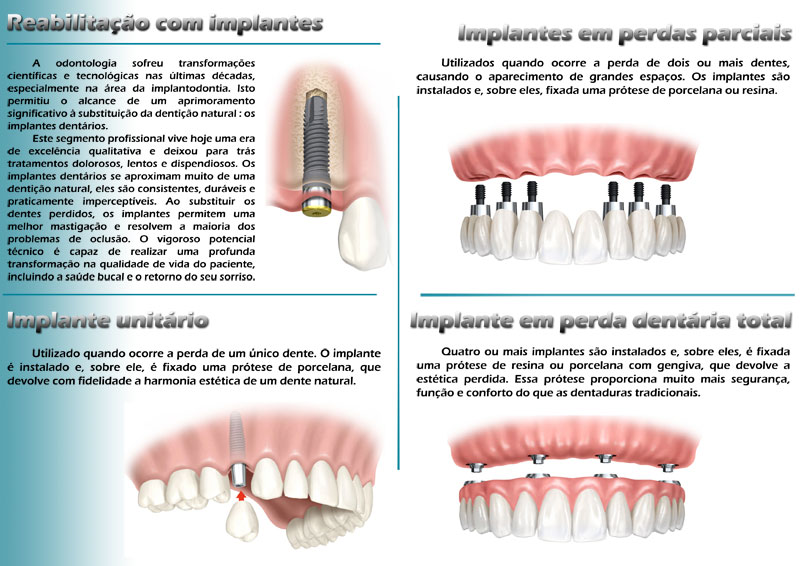Partes do implante dental