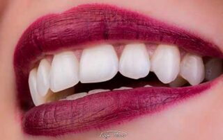 dentes perfeitos