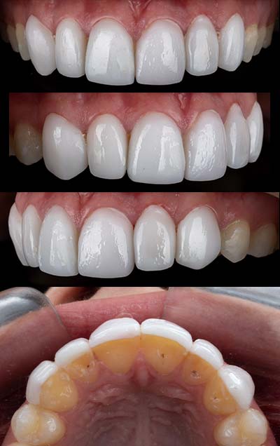 refazer-lente-de-contato-dental Refazer lente de contato dental